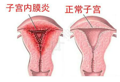 全自动阴道分泌物午夜精品无码免费视频厂家子宫内膜炎的症状表现提前了解与预防